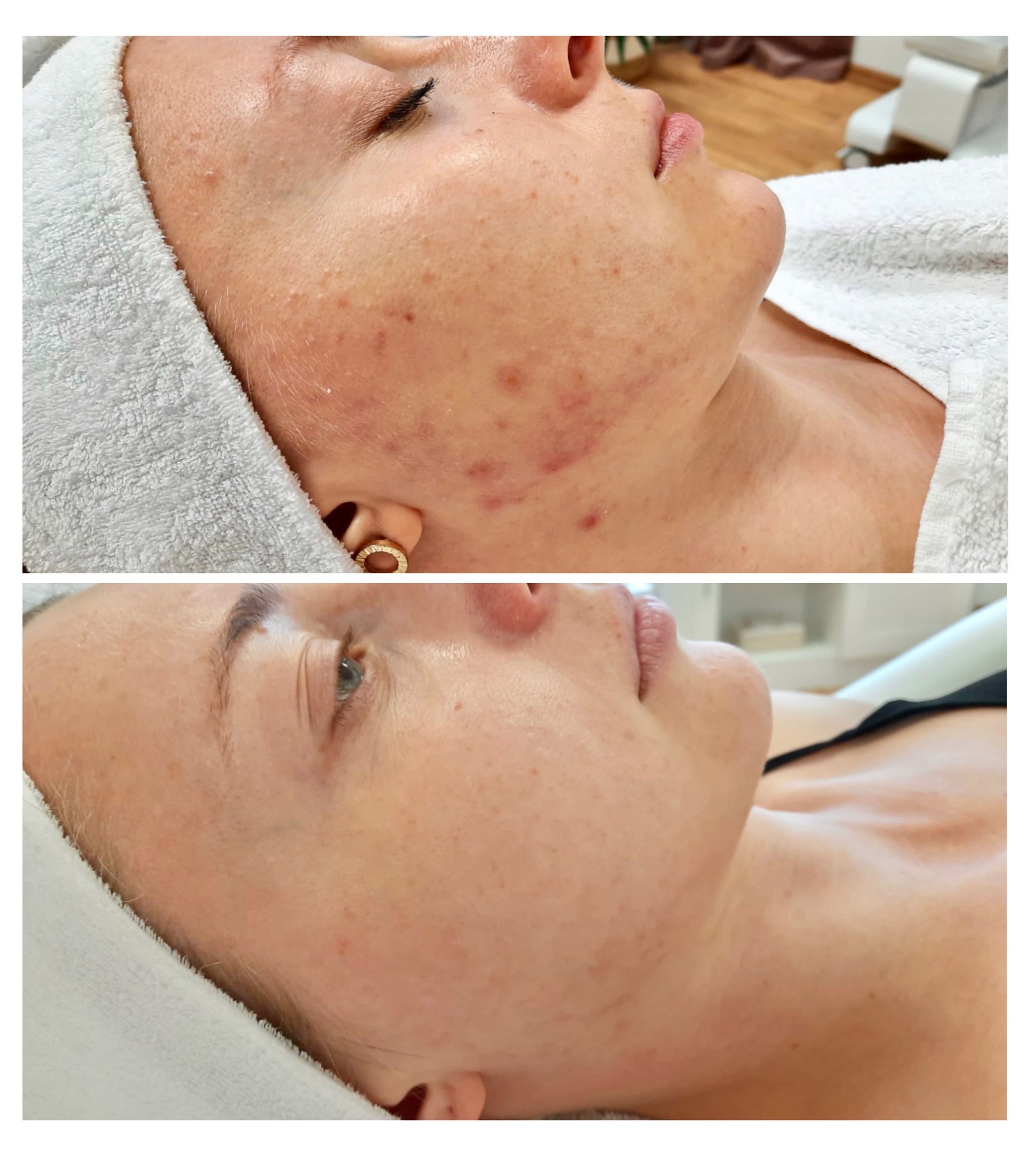 Čištění pleti - foto studio Lanškroun