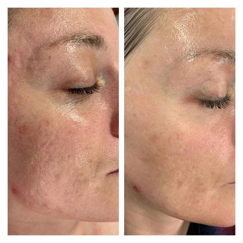 Výsledek ošetření OxyGeneo