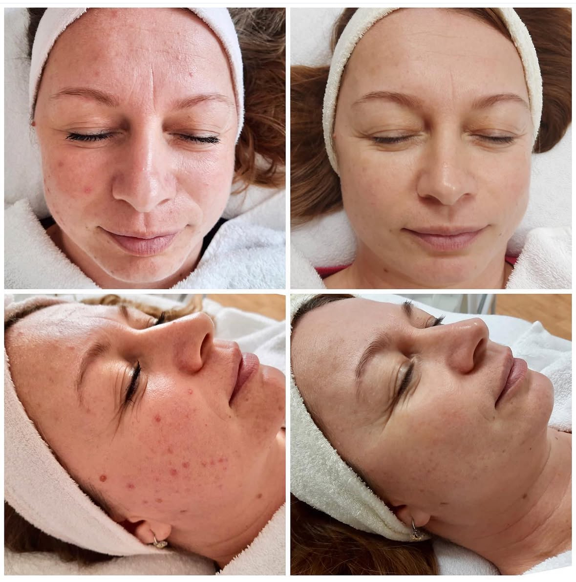 Diamantová dermabraze studio Lanškroun
